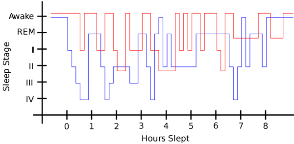 Restless leg syndrome sleep vs normal sleep.svg