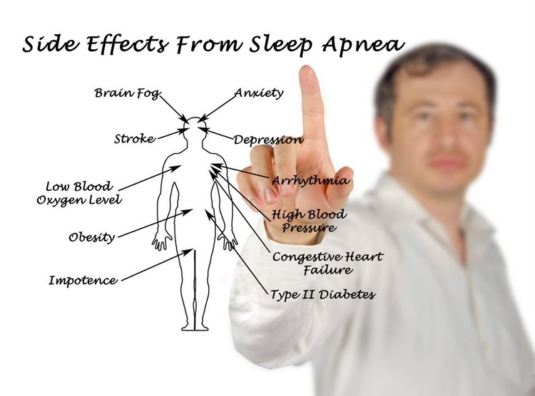 Overview of Obstructive Sleep Apnea (OSA)
